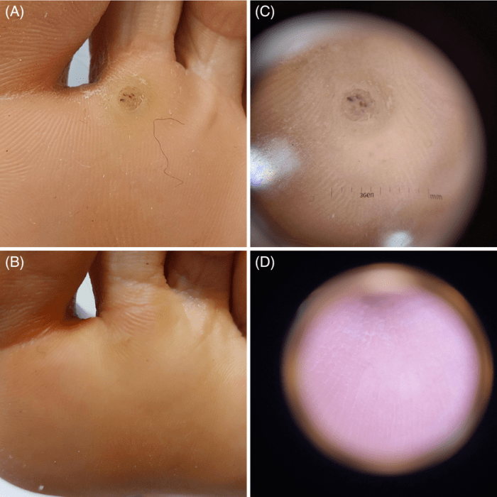 Cara menghilangkan kutil dengan terapi cryotherapy